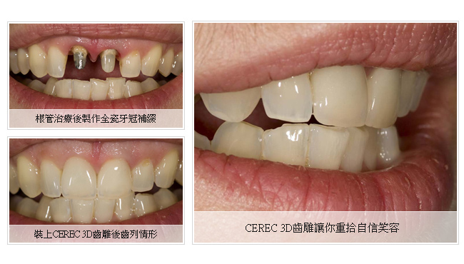 根管治療後製作全瓷牙冠補綴