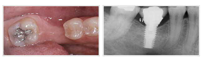 植牙手術評估 解決缺牙困擾