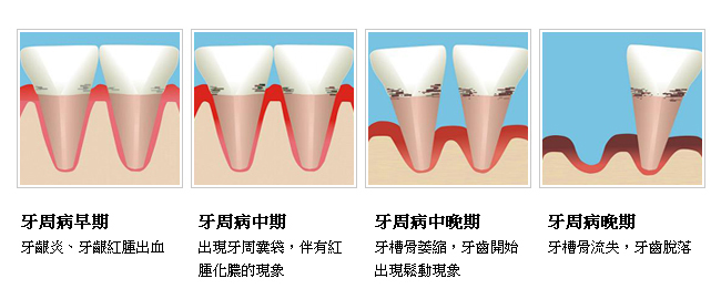 牙周病可能的症狀